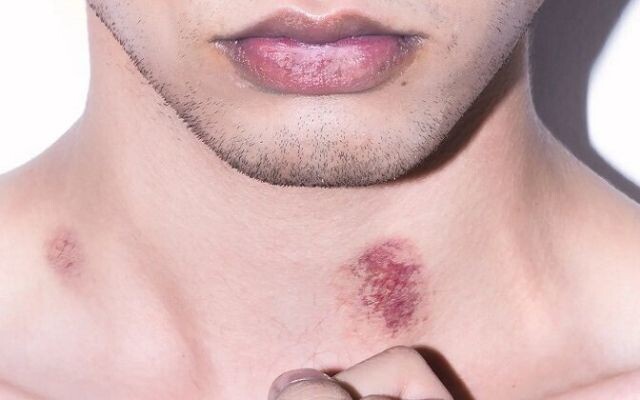 Tìm hiểu những nguy hại của hickey